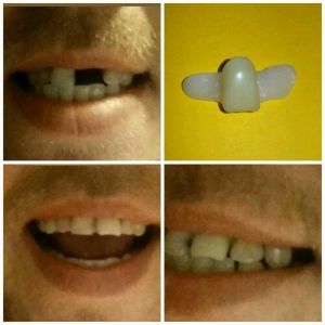 Temporary Replacement Front Tooth (Instantly Smile) Central Incisor